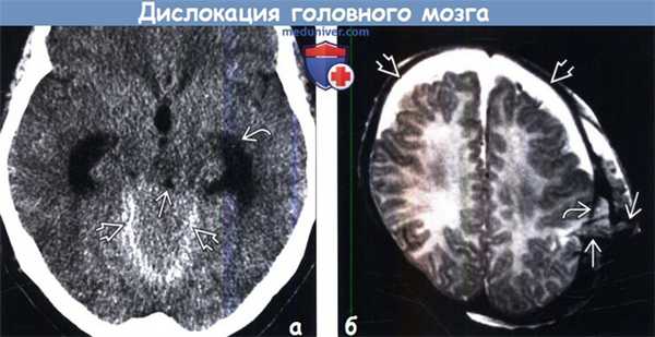 Дислокация головного мозга на КТ, МРТ