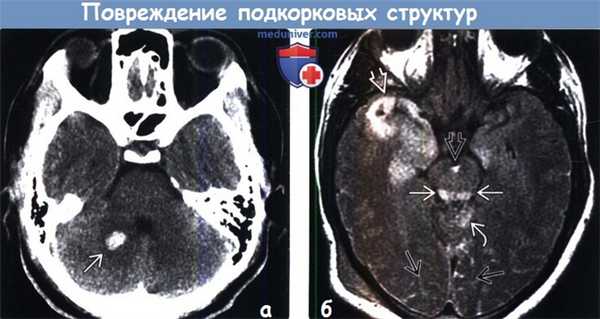 Повреждение подкорковых структур на КТ, МРТ