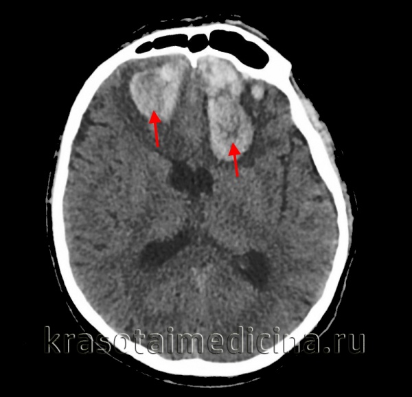 КТ головного мозга. Внутримозговые (интрапаренхиматозные) травматические гематомы с обеих сторон