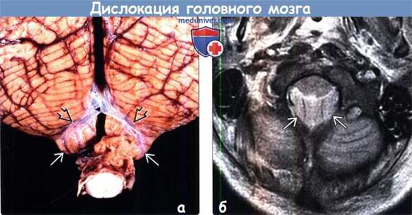 Дислокация головного мозга на МРТ
