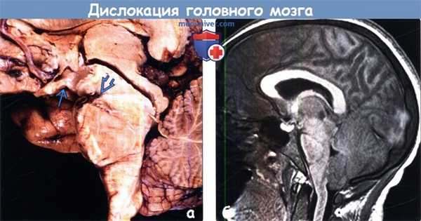 Дислокация головного мозга на МРТ