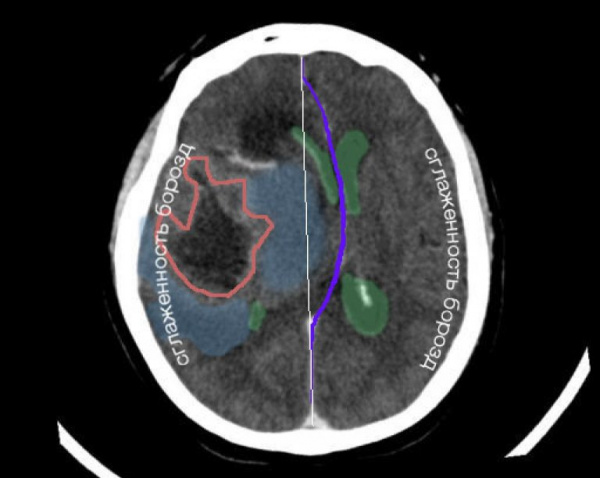 Признаки дислокации мозга