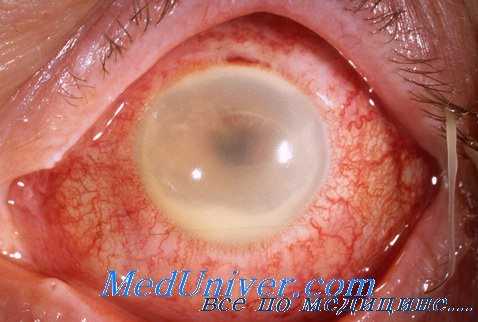 введение антибиотико в глаза