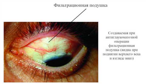 Глаукома лечение