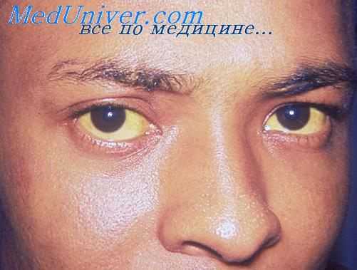 печеночная недостаточность