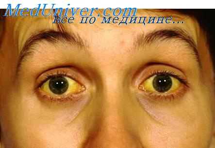 желтуха при печеночной недостаточности