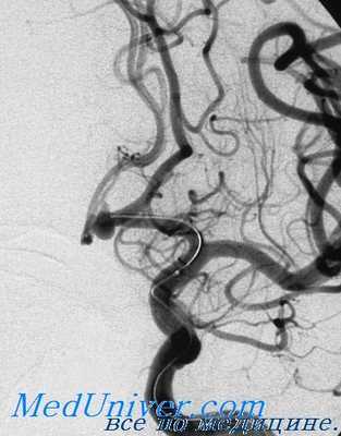 ампутация при травме артерии и костей
