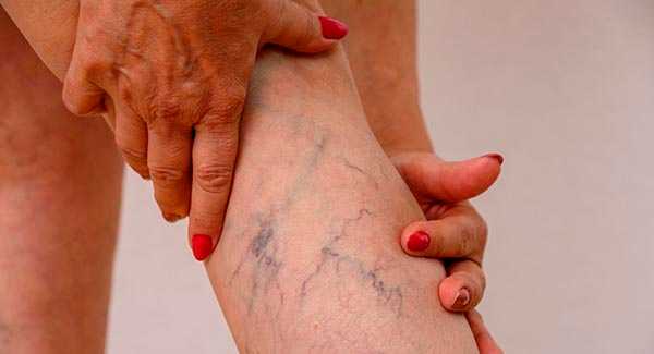 Шунтирование вен