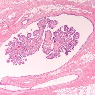 Внутрипротоковая папиллома молочной железы