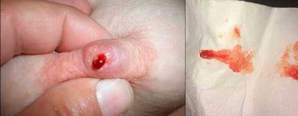 Кровь из сосков