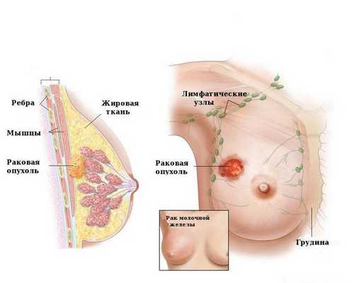 Рак груди