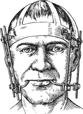Шина в собранном виде, укрепленная на голове