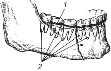 Составные элементы назубной шины