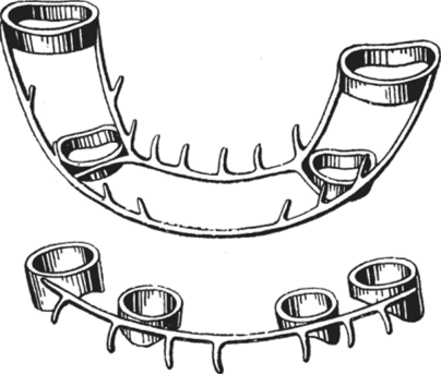 Шина на кольцах с крючками для вытяжения отломков
