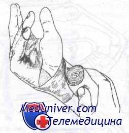 внесуставные переломы проксимальных фаланг кисти