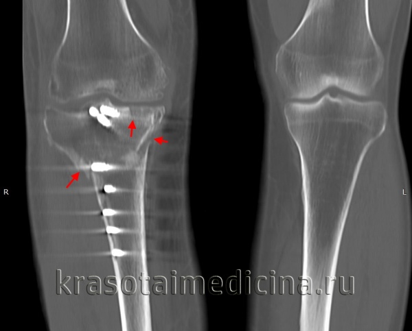 Внутрисуставной перелом