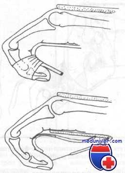 внесуставные переломы проксимальных фаланг кисти