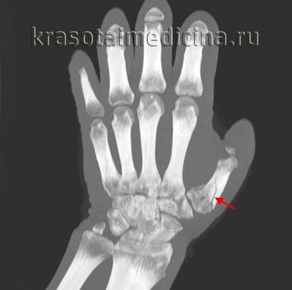 КТ кисти. Оскольчатый перелом первой пястной кости правой кисти со смещением отломков.