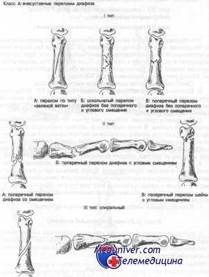 внесуставные переломы проксимальных фаланг кисти