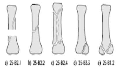 Классификация переломов пястной кости