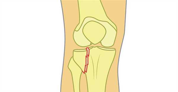 Внутрисуставный перелом