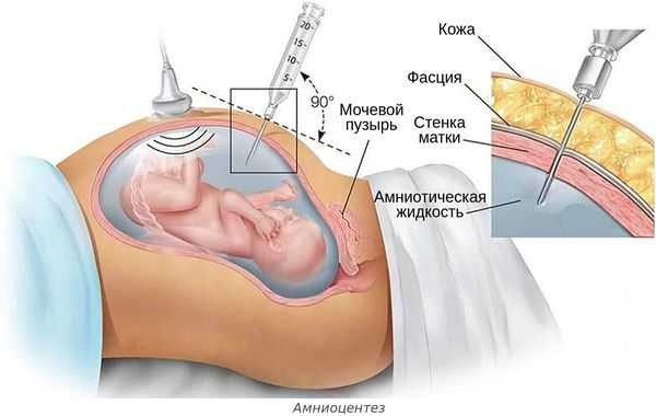 Амниоцентез