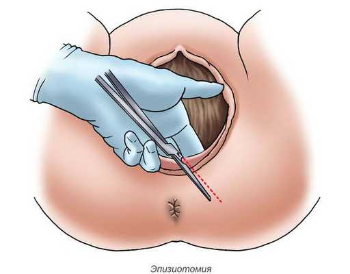 Эпизиотомия