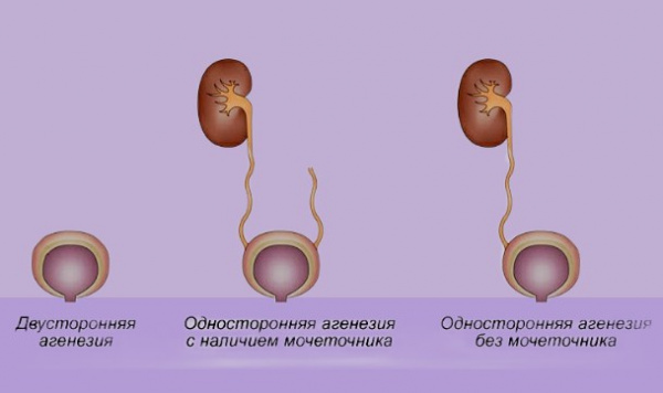 Врожденные аномалии мочеточника
