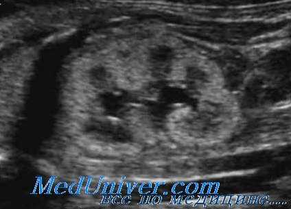 диагностика аномалий почек у плода по УЗИ