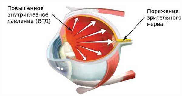Причины развития глаукомы у взрослых и детей