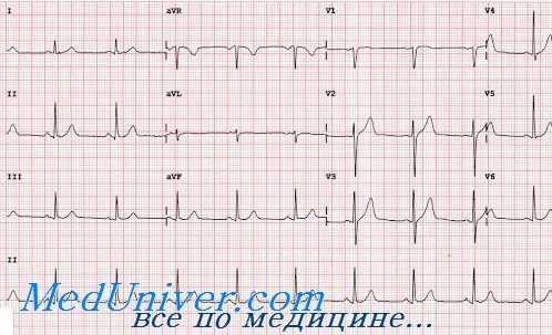 сердечный диполь