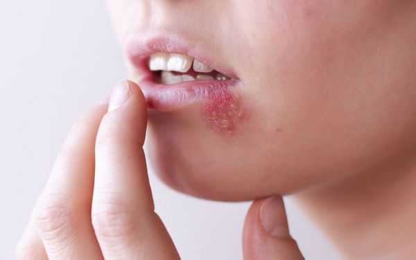 Герпетический стоматит