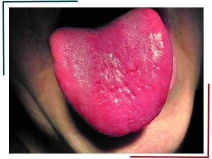 Атрофический глоссит Источник: qstoma.ru