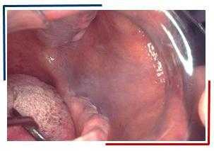 Лейкоэдема