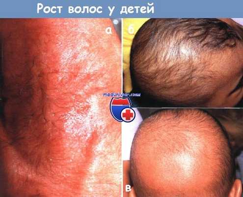 Рост волос у детей