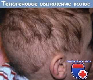 Телогеновое выпадение волос
