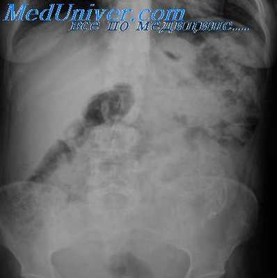 удвоение желудка