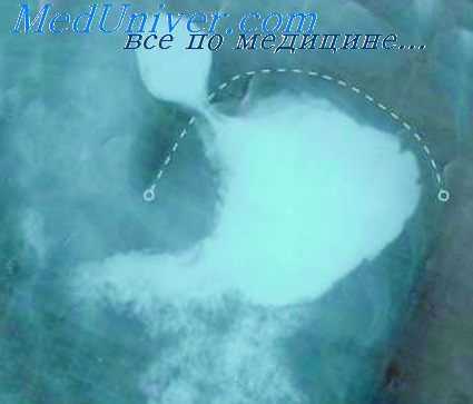 дивертикул желудка