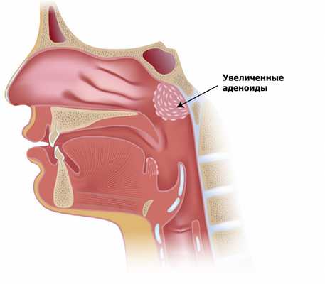 shutterstock_119134837 аденоиды.jpg