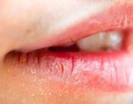 Аллергический хейлит