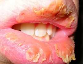 Эксфолиативный хейлит