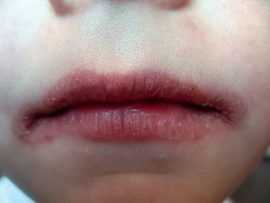 Экзематозный хейлит