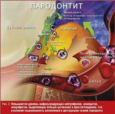Повышается уровень инфильтрирующих нейтрофилов, моноцитов, макрофагов, выделяющих больше цитокинов и простагландинов