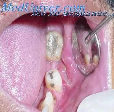 подчелюстная железа и ее воспаление