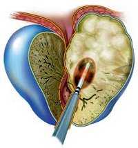 Острый простатит