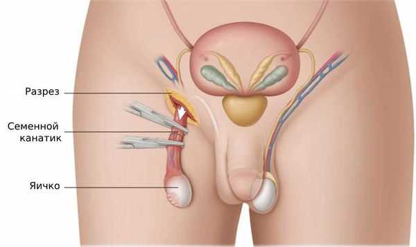 Орхоэпидидимэктомия