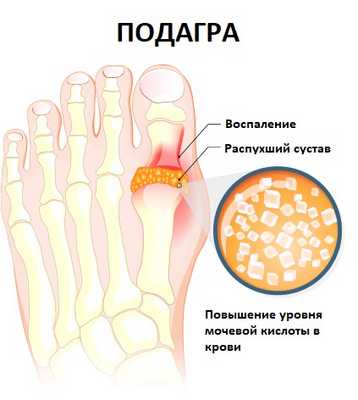 Подагра.jpg
