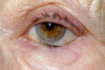 Глазное заболевание - заворот века