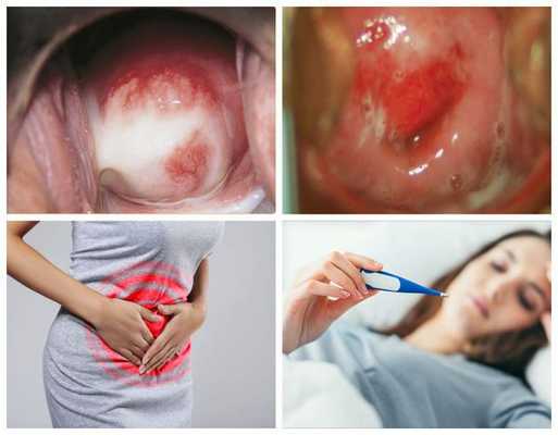 Признаки цервицита