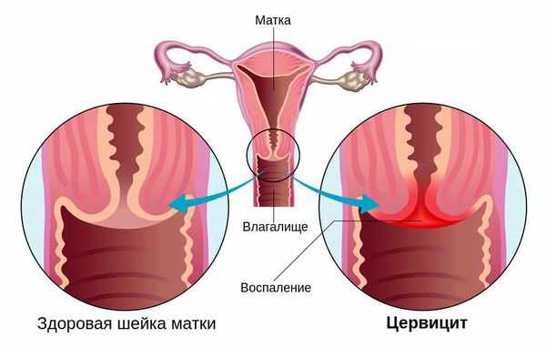 Воспаление цервикального канала шейки матки